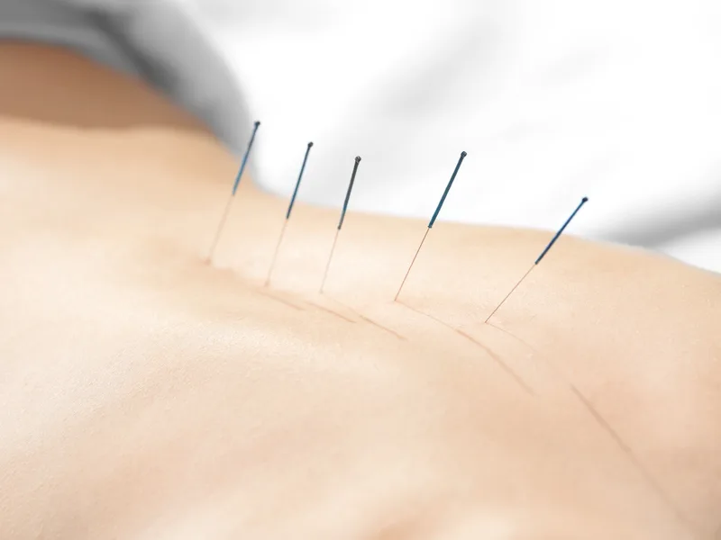 Acupuncture at Northern Roots Family Spinal Care in Clear Lake
