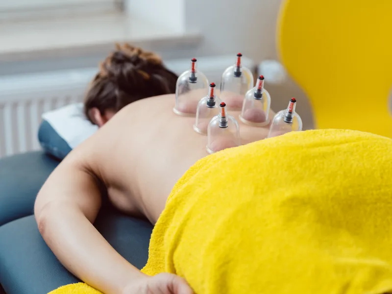 Cupping Therapy at Northern Roots Family Spinal Care in Clear Lake