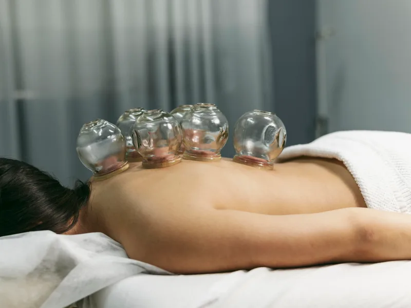 Cupping Therapy at Northern Roots Family Spinal Care in Clear Lake