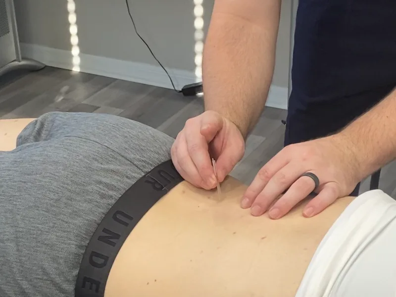 How Dry Needling works at Northern Roots Family Spinal Care