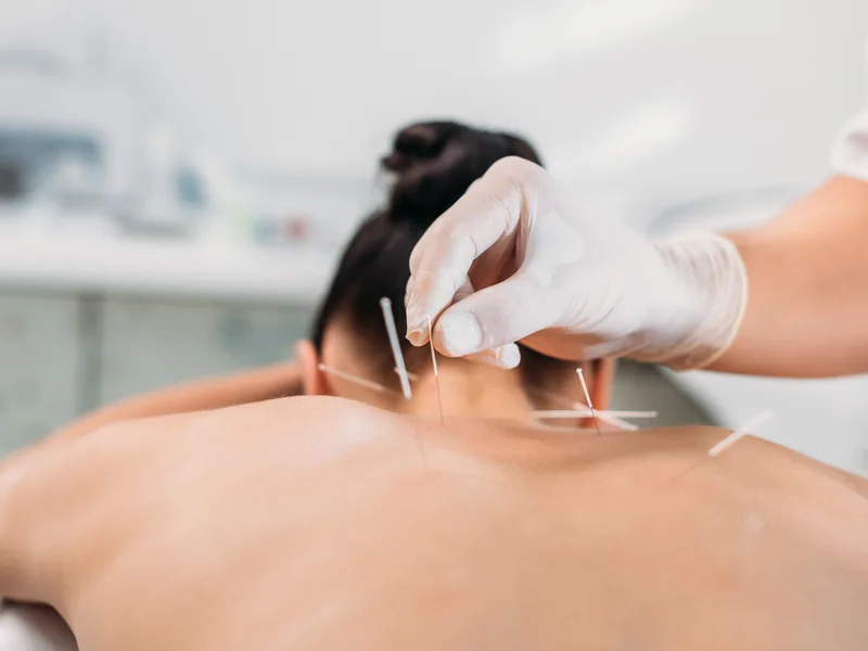 Dry Needling at Northern Roots Family Spinal Care in Clear Lake